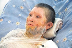 Необходима помощь: женщина получила 50% ожог тела открытым пламенем