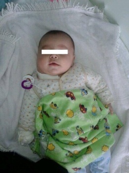 Мальчику на фото был всего один год, когда у него удалили огромную опухоль на шее. Ребенку провели курс химиотерапии. Сейчас он здоров.
