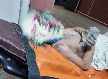 В Бишкеке мужчина облил себя бензином. У него 30 процентный ожог тела